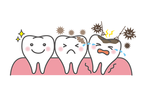 むし歯