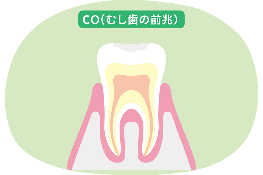 超初期むし歯(CO)
