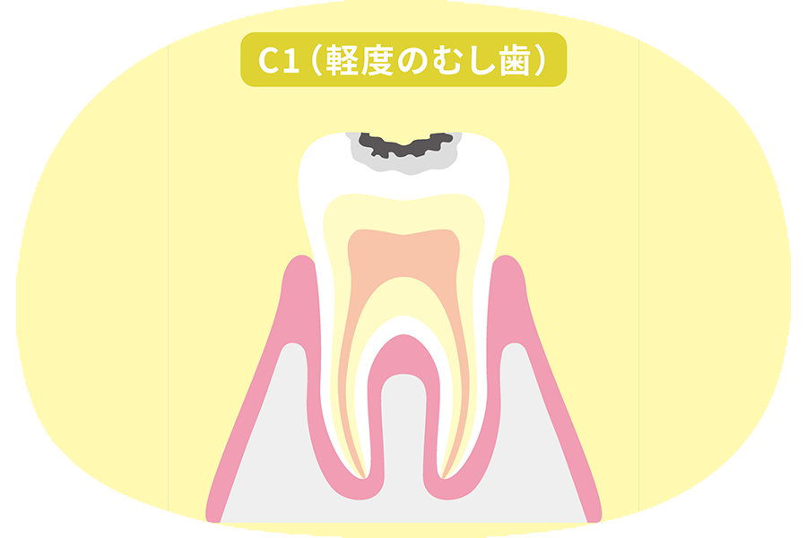 初期むし歯(C1)