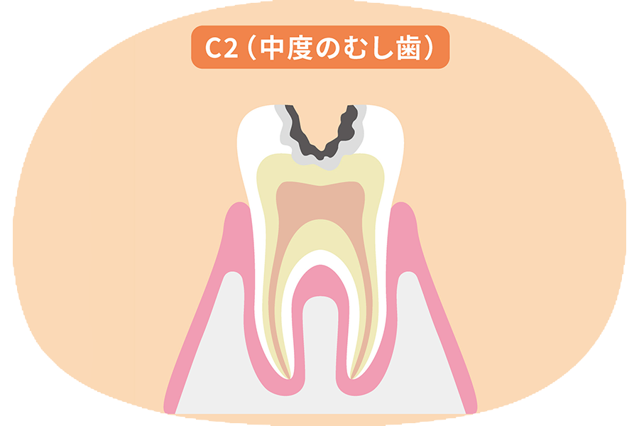 象牙質まで進行したむし歯(C2)