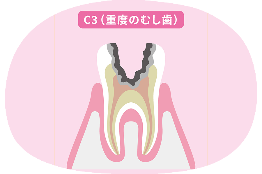神経まで進行したむし歯(C3)