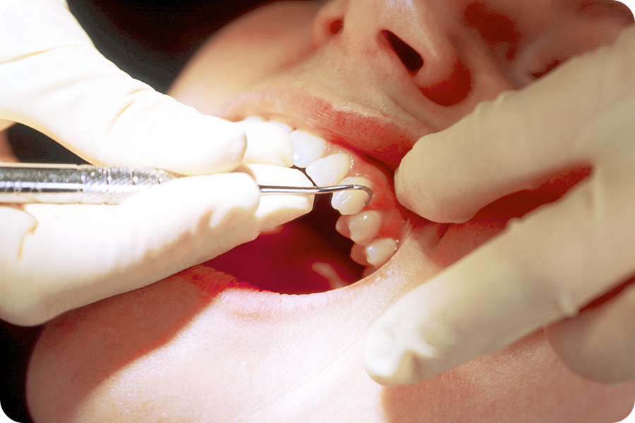 進行した歯周病の治療