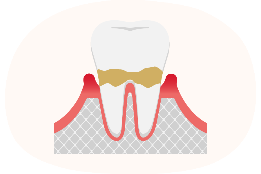 歯周炎(軽度)